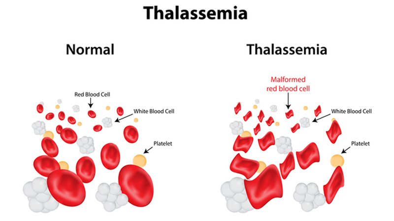 thalassemia nhung dieu can biet 1