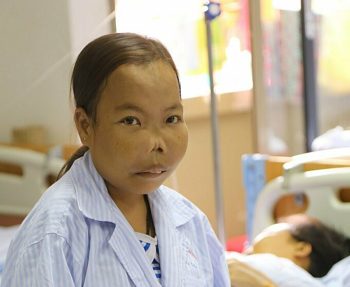 benh-nhan-mac-thalassemia