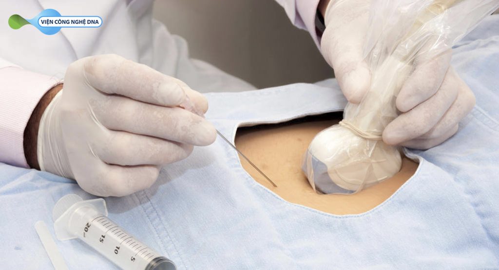 Xét nghiệm nước ối để phát hiện nhiễm sắc thể khác thường của bào thai