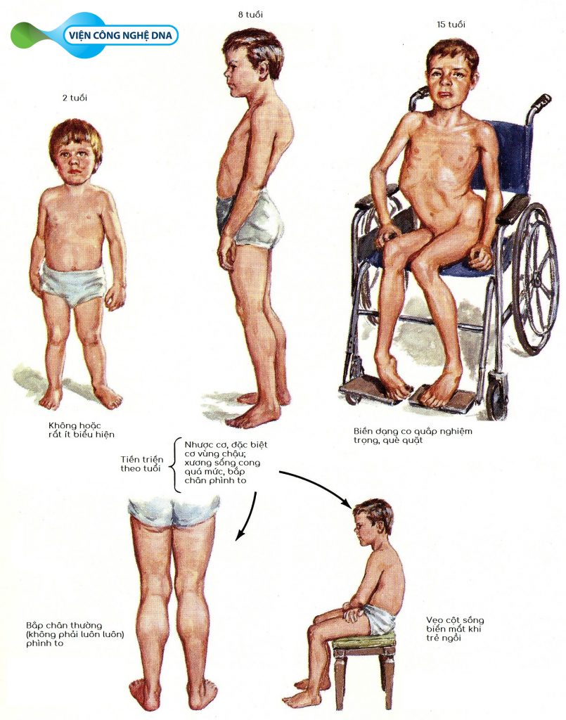 3 duchenne viencongngheDNA 01 1