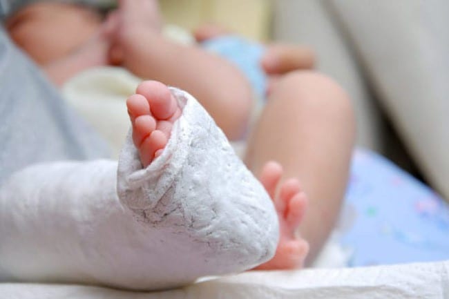 Dị tật bẩm sinh: Khèo chân bẩm sinh