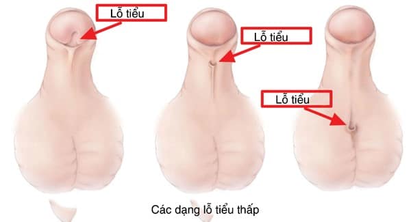 6 dị tật bẩm sinh thường gặp: Hội chứng lệch lỗ niệu đạo