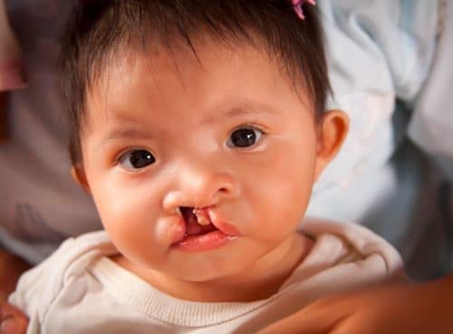 6 dị tật bẩm sinh thường gặp: Dị tật sứt môi và hở hàm ếch