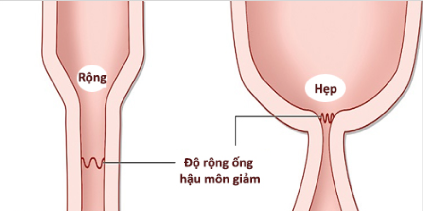 duong-hau-mon-bi-hep