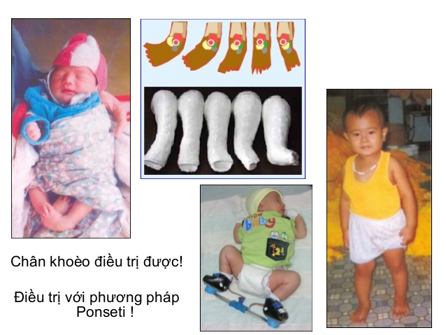Vì sao trẻ bị bàn chân khoèo bẩm sinh? 6 dieu-tri-chan-khoeo-bam-sinh
