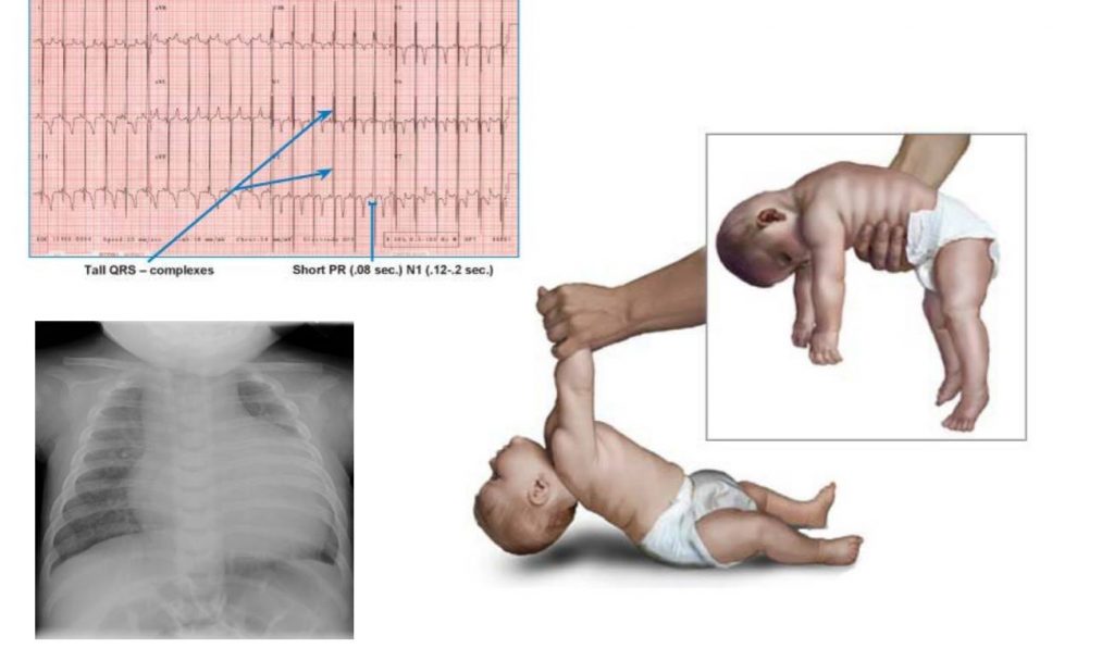 Pompe là bệnh lý di truyền về rối loạn thần kinh cơ