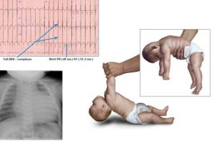 Pompe – Bệnh rối loạn chuyển hóa hiếm gặp khiến trẻ chết dần