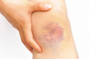 Máu khó đông – bệnh ‘nhà giàu’ thường truyền cho con trai