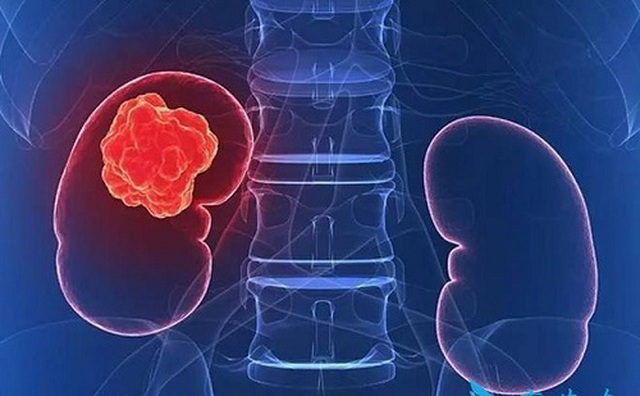 Thay đổi trong quá trình tiêu hóa là 1 trong những dấu hiệu cảnh báo ung thư