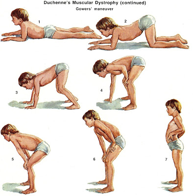 Cách chăm sóc trẻ bị mắc loạn dưỡng cơ Duchenne