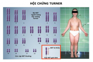 [Tư vấn] Sảy thai nhiều lần do hội chứng Turner