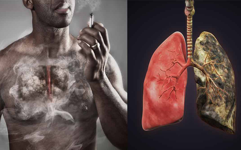 Phương pháp mới chữa trị ung thư phổi hiệu quả 