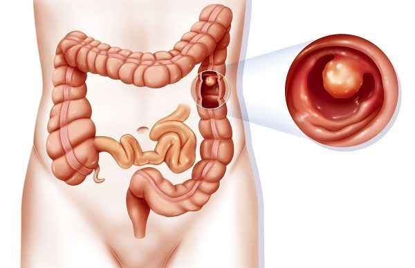 Hội chứng Lynch vẫn được gọi là hội chứng ung thư đại tràng không polyp di truyền (HNPCC)