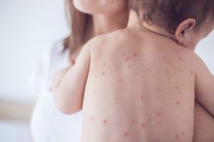 9 dấu hiệu cảnh báo ung thư máu ở trẻ em