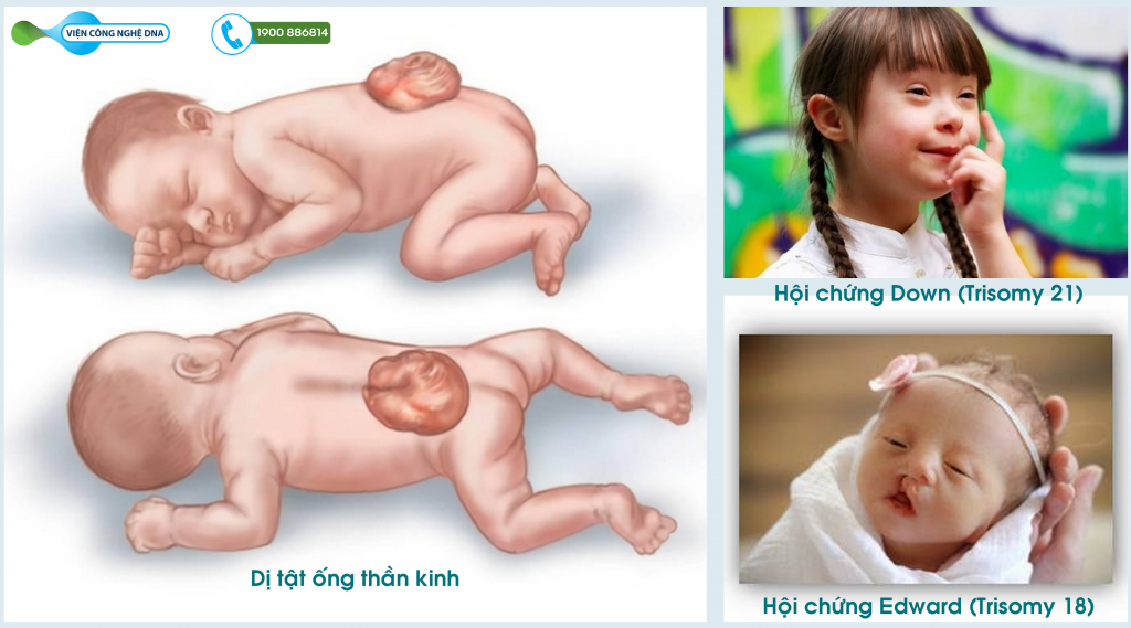 Một số dị tật ở thai nhi có thể gặp phải khi mẹ sinh con ngoài 35