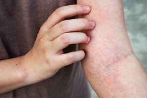Ngứa- dấu hiệu ung thư bạn không nên bỏ qua