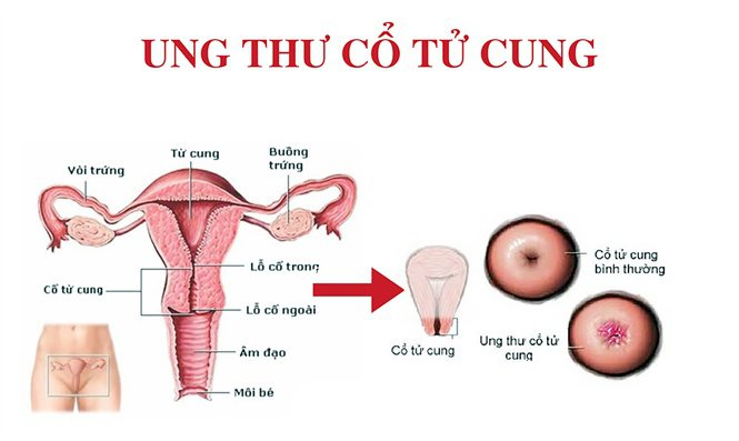 5 loai ung thu thuong gap o nu gioi 02