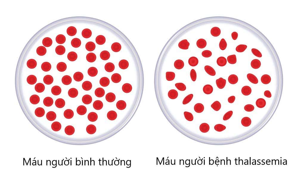 benh tan mau bam sinh co ngu hiem khong 2