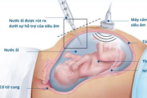 [Kiến thức] 5 câu hỏi thường gặp về chọc ối