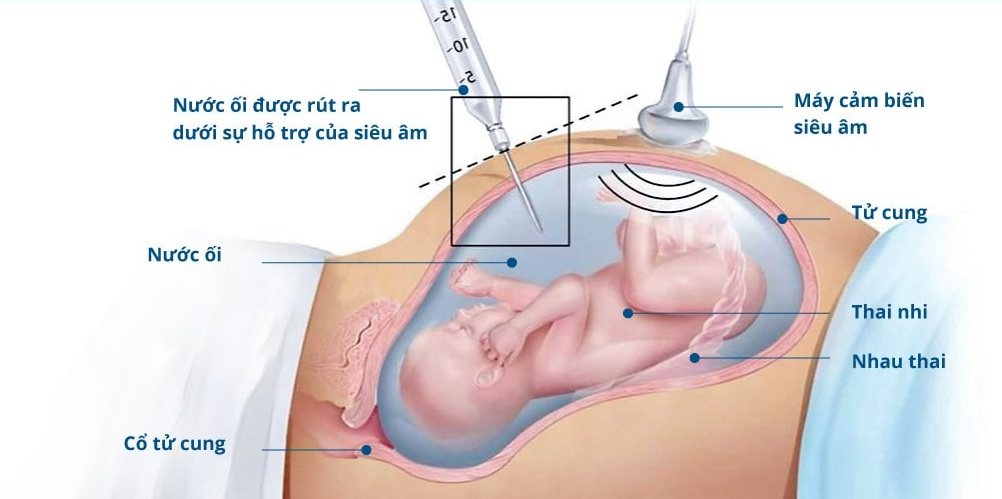 Chọc ối là thủ thuật không cần gây mê