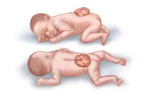 Những nguyên nhân chính gây dị tật bẩm sinh