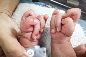 Cơ chế gây ra hội chứng Edwards ở thai nhi