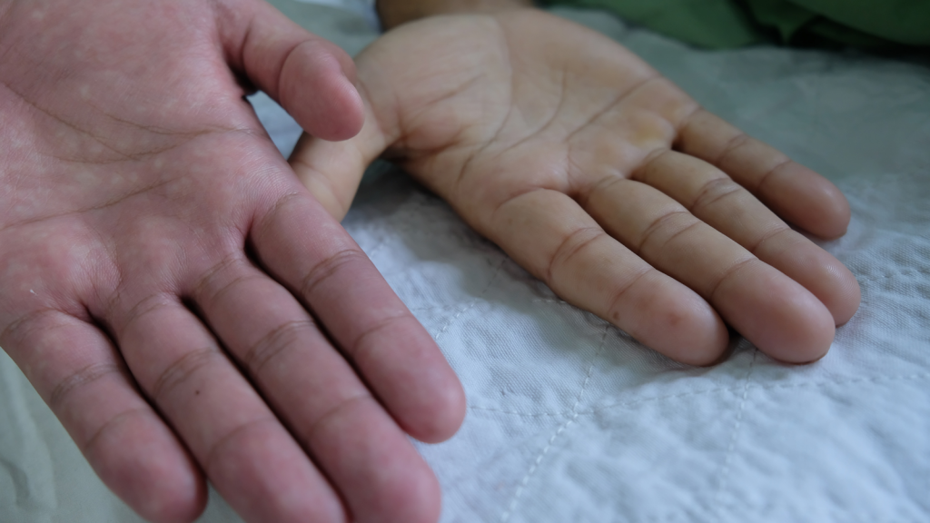 Trieu chung benh Thalasemia 01