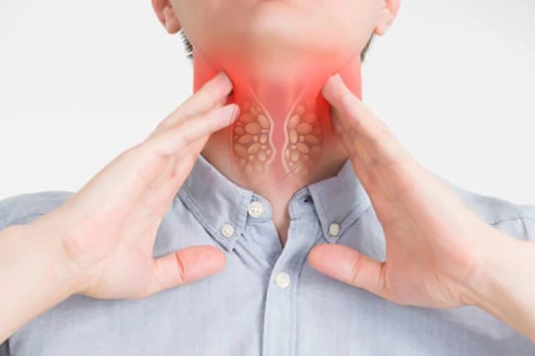 Triệu chứng ung thư ở nam giới: Sưng hạch bạch huyết