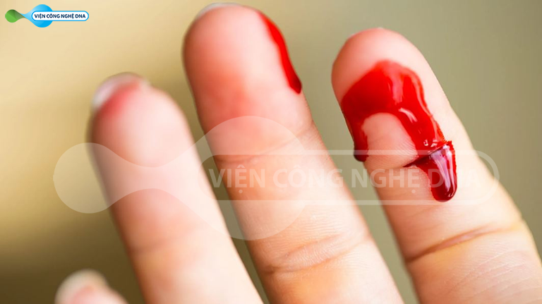 Benh mau kho dong la gi va cac dieu tri 02