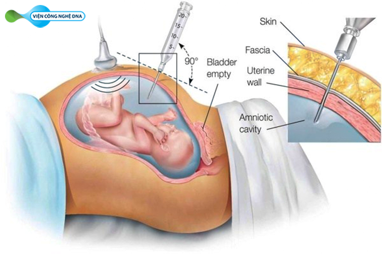 Không nên chọc ối nếu không có sự tư vấn của bác sĩ chuyên khoa
