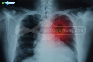 5 loại ung thư thường gặp ở phụ nữ và cách phòng ngừa