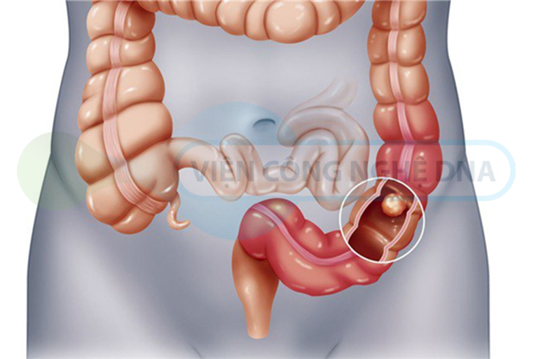 Ung thư đại tràng là sự tăng sinh quá mức các tế bào biểu mô đại tràng