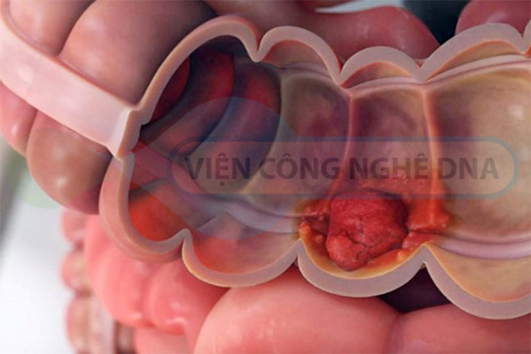 Thủng ruột là biến chứng thường gặp của ung thư đại tràng