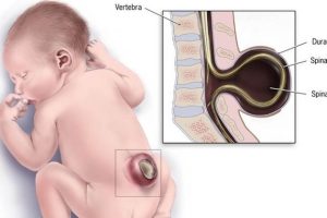 Phòng ngừa và điều trị dị tật bẩm sinh nứt đốt sống ở trẻ