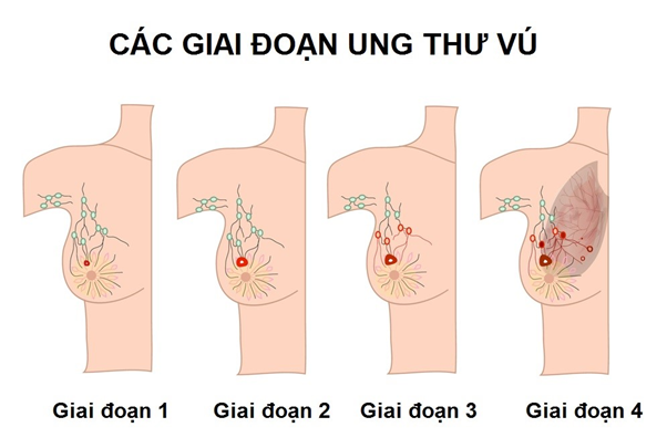 4 giai đoạn của ung thư vú