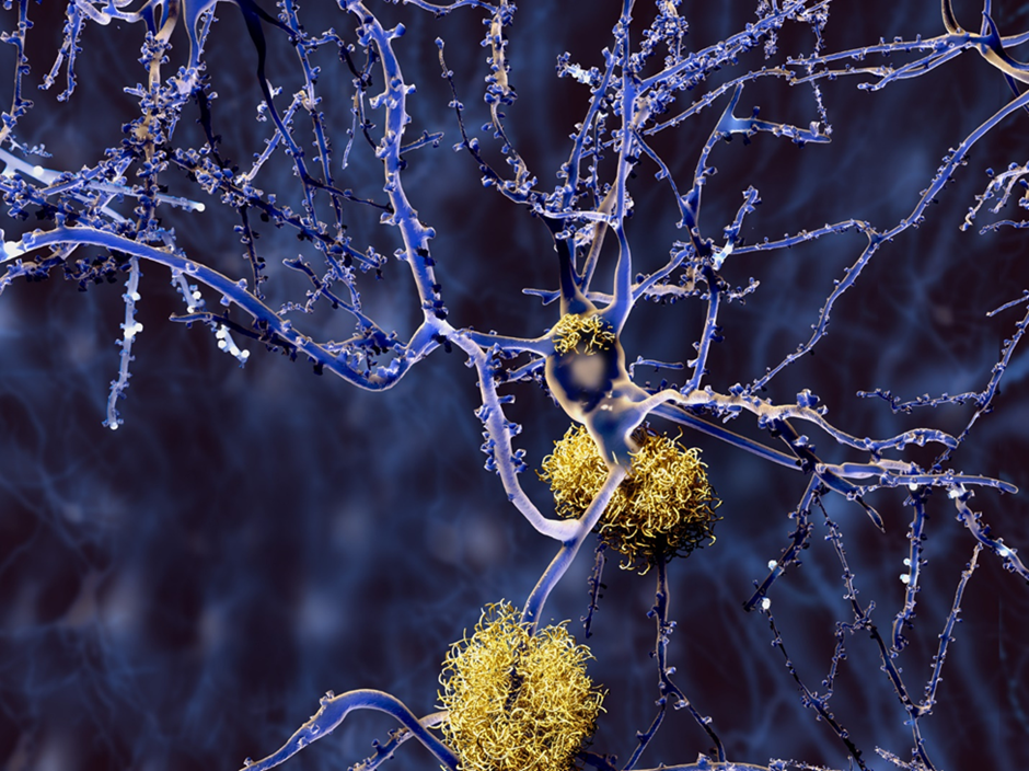 Alzheimer co phai la benh di truyen khong 02