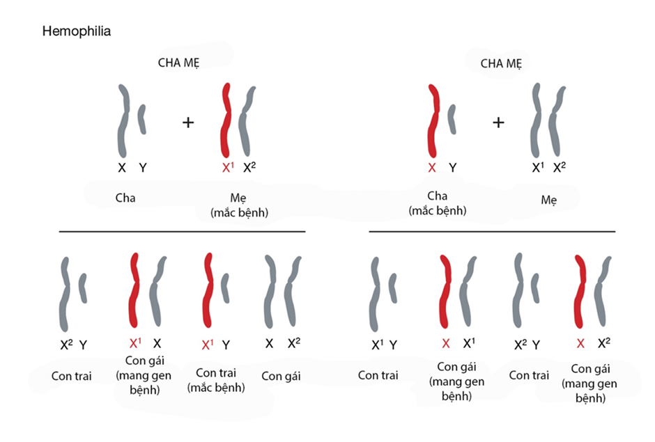 Cac xet nghiem di truyen lien quan den can benh mau kho dong Hemophilia A 02