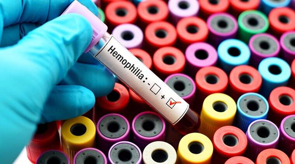Cac xet nghiem di truyen lien quan den can benh mau kho dong Hemophilia A 03