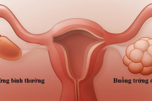 Chế độ ăn uống cho phụ nữ bị buồng trứng đa nang