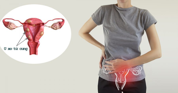 U xơ tử cung có thể ảnh hưởng đến khả năng mang thai