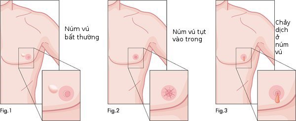 17 trieu chung som canh bao ung thu nam gioi nhat dinh phai biet 04