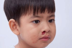 Cơ chế di truyền bệnh Hemophilia như thế nào? 