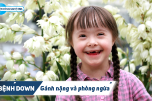 Bệnh Down – Gánh nặng và phòng ngừa