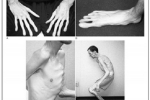Hội chứng Marfan – Triệu chứng, nguyên nhân và phòng ngừa