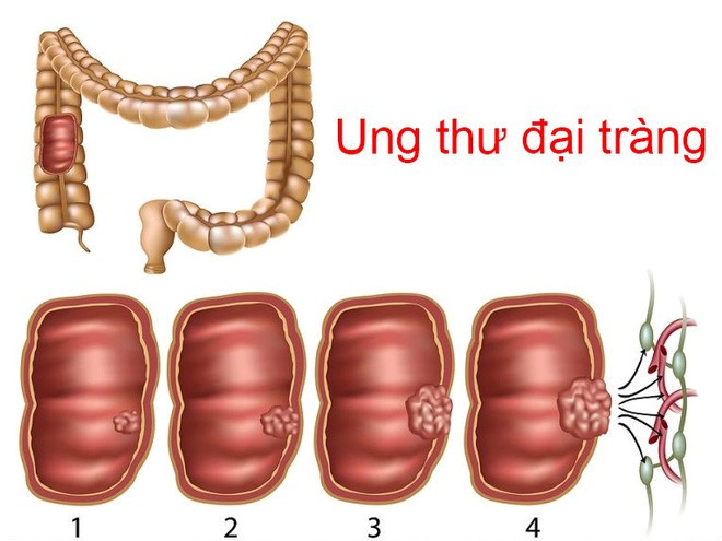 ung thu dai trang 16298971231411264980046