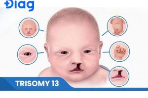 Trisomy 13 là gì? So sánh với Trisomy 18 và Trisomy 21