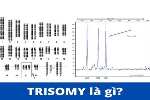 Trisomy là gì? Những dấu hiệu phát hiện sớm qua sàng lọc thai kỳ